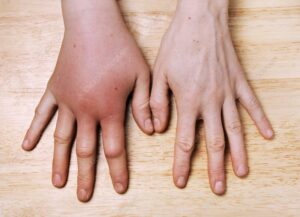 Méhszúrás allergia tünetei